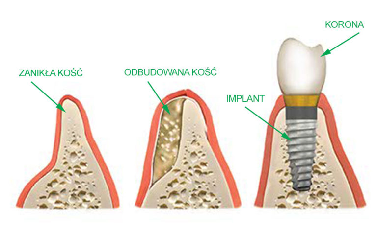 Na Czym Polega Odbudowa Ko Ci Klinika Stomatologiczna Implanty